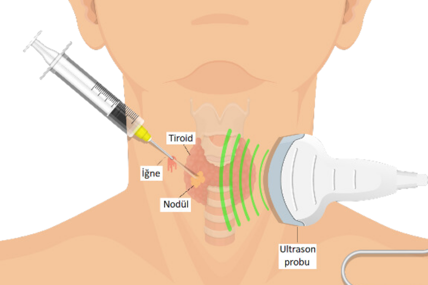 Tiroid İnce İğne Aspirasyon Biyopsisi