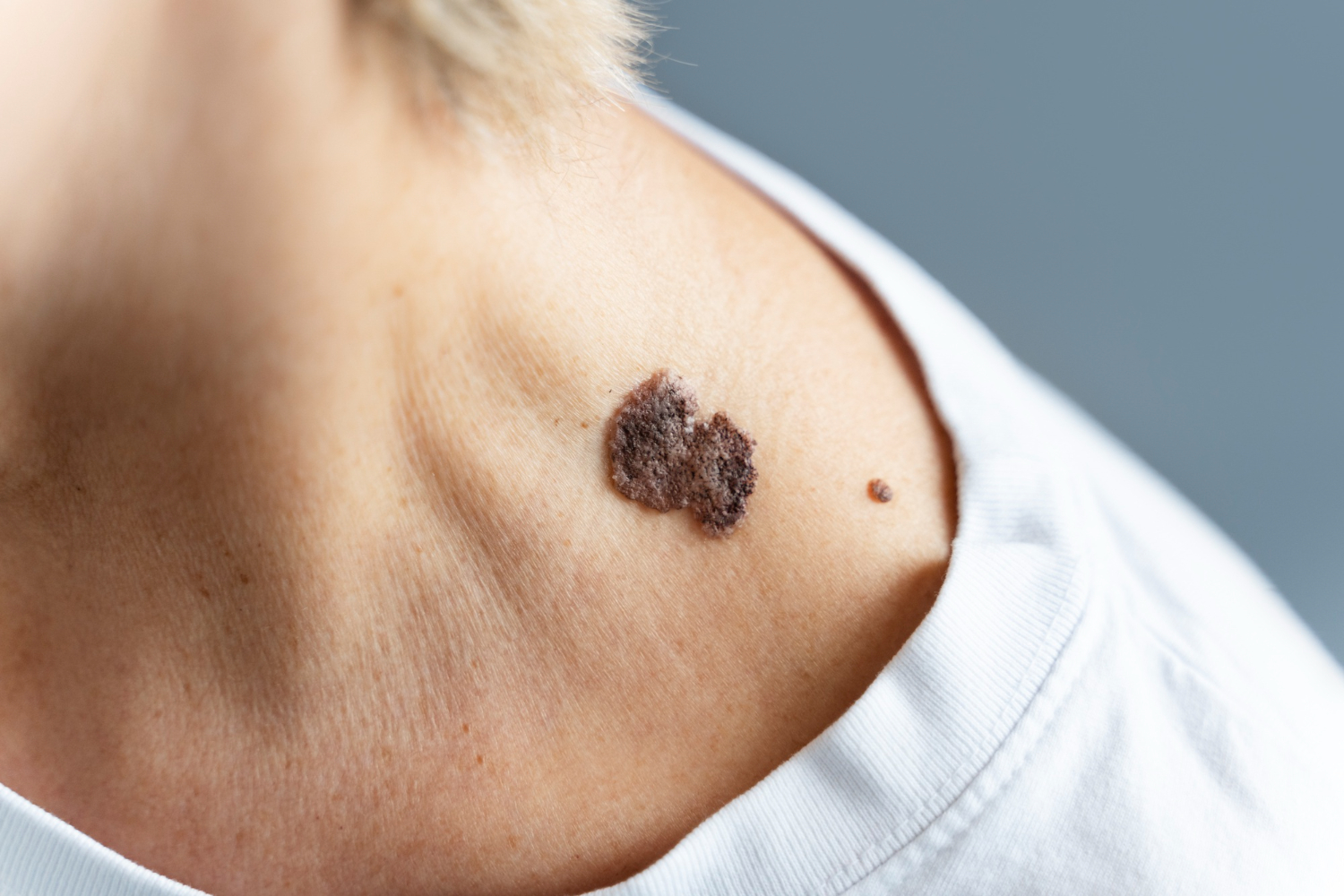 Cilt Melanomu
